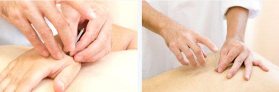 acupuncture2