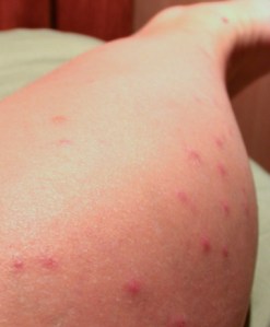 blog-2_df_midges-sand-flies_bites_dr